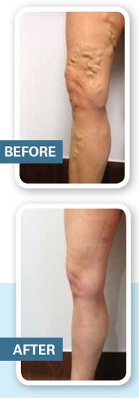 Can Varicose Veins Affect People In Shape - Indiana Vein Specialists