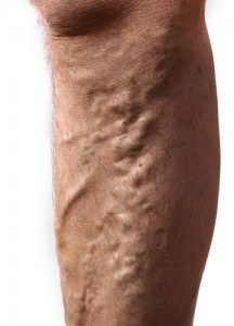 Occupations Most at Risk for Varicose Veins - How to Help