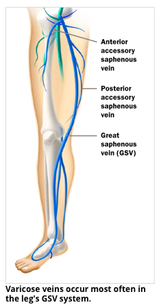 Deep Vein Thrombosis DVT - Indiana Vein Specialists