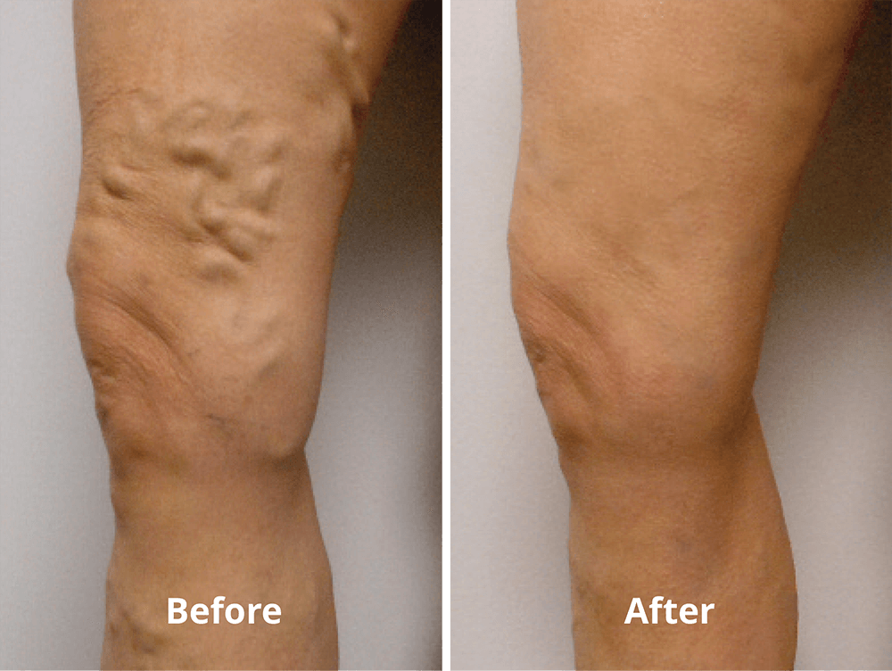 Deep Vein Thrombosis Treatments - Beyond Podiatry