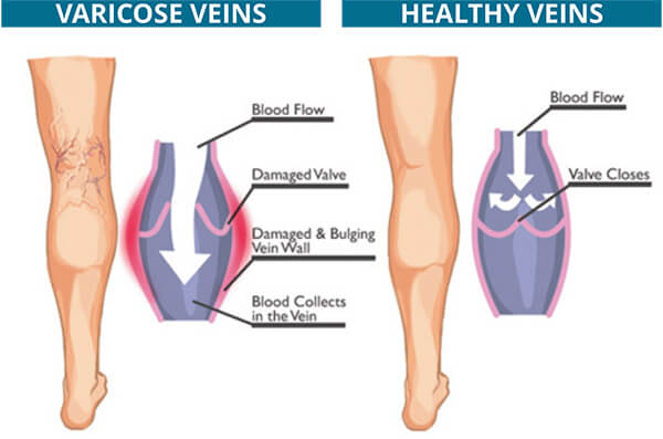 Early Warning Signs of Chronic Venous Insufficiency - Vein Solutions