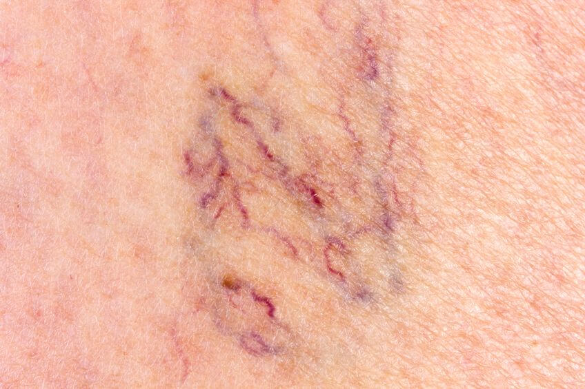 Spider Veins - Indiana Vein Specialists