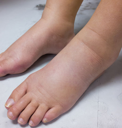 Chronic Venous Insufficiency and Lymphedema - Lymphedema Therapy Specialists